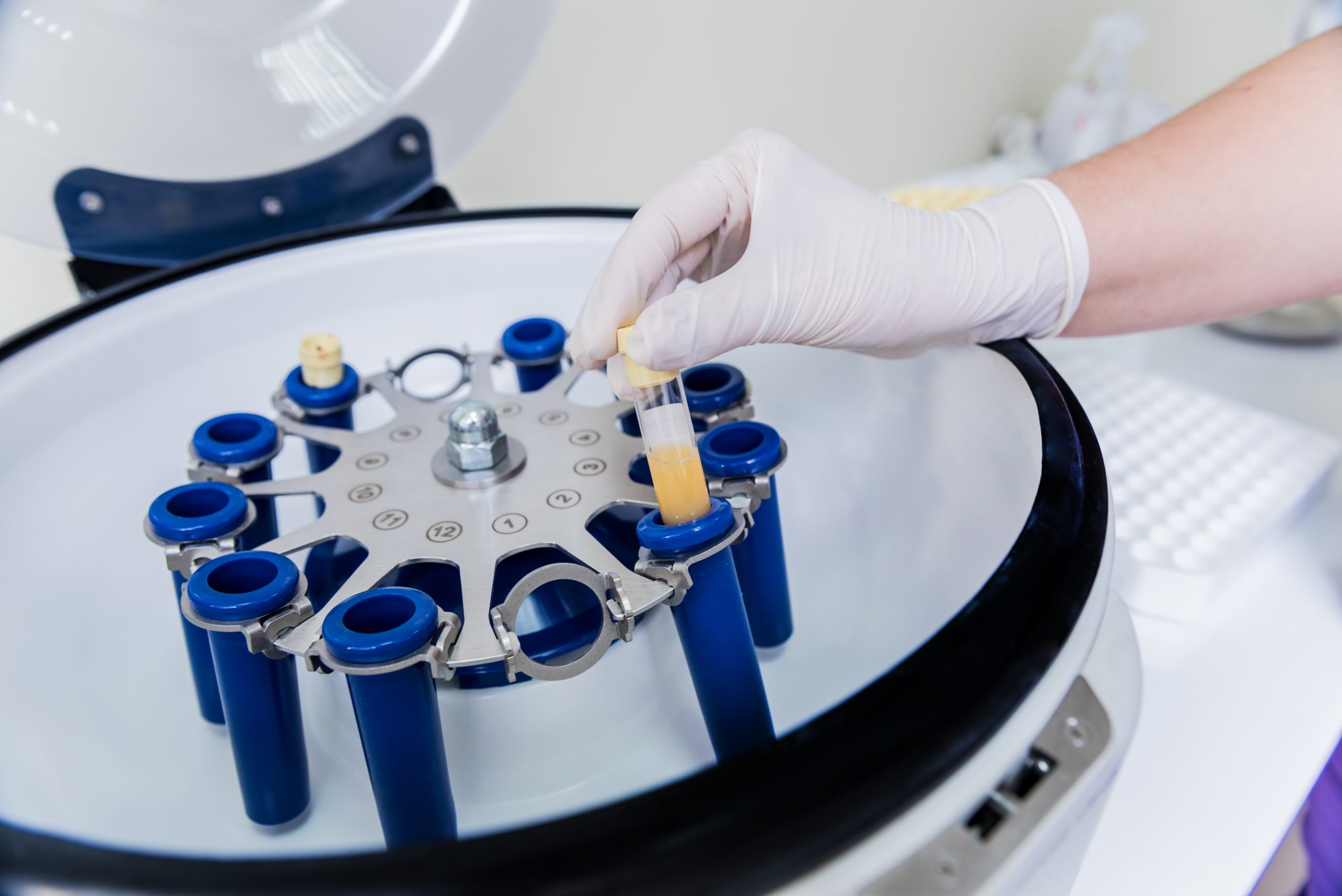 PRF Capilar treatment